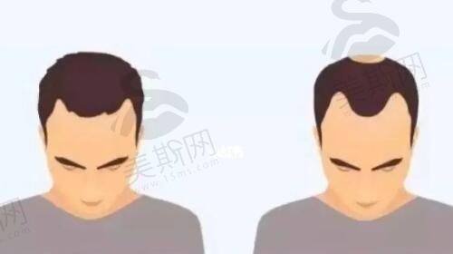 杭州阿波罗医院男性私密整形收费价格表：玻尿酸增粗2680，生物补片12880，收费贵吗？正规吗？