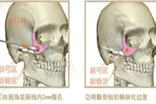 杭州阿波罗男子医院正规吗