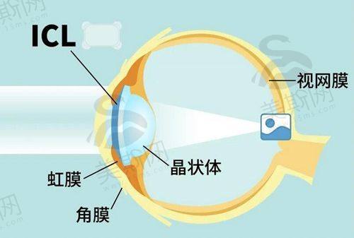 2025西安四院眼科近视手术价格表