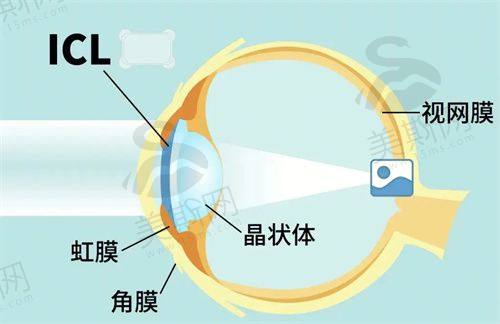 四大术式价格与口碑对比