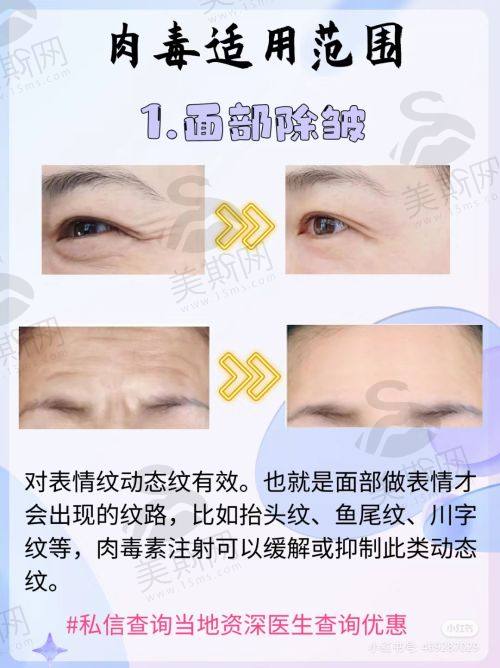 富贵包哪家医院做手术好