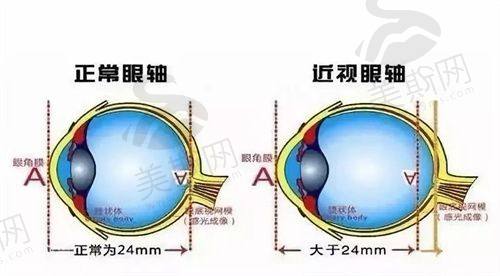 南京明康/东南/华厦眼科飞秒激光技术对比：全飞秒VS半飞秒怎么选？