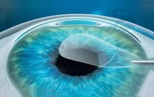 贵州省人民医院晶体植入近视手术价格