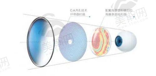 高度散光手术多少钱？2025年全新价格表+医疗保险报销说明