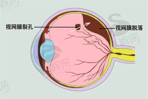 天津近视眼手术术前必看：3个省钱技巧+避坑指南