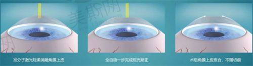五百度散光可以做手术吗