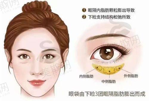 郑州王杨医生眼袋修复卧蚕技术优势
