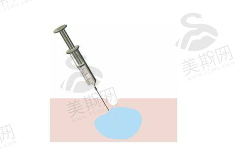 卢元刚医生拉皮技术大剖析