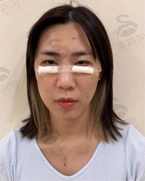 郑州王杨医生个人简历揭秘：眼袋修复卧蚕技术惊艳，附详细介绍与成功案例价格