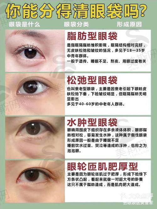 郑州王杨医生眼袋修复卧蚕真实实例