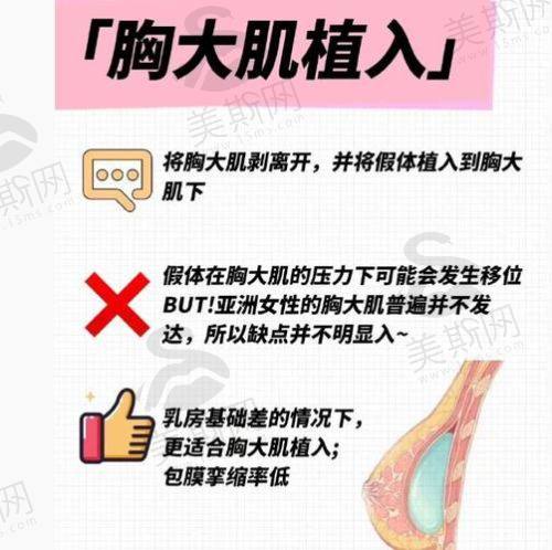 7. 乳沟成形技术：性感深邃，穿衣自由