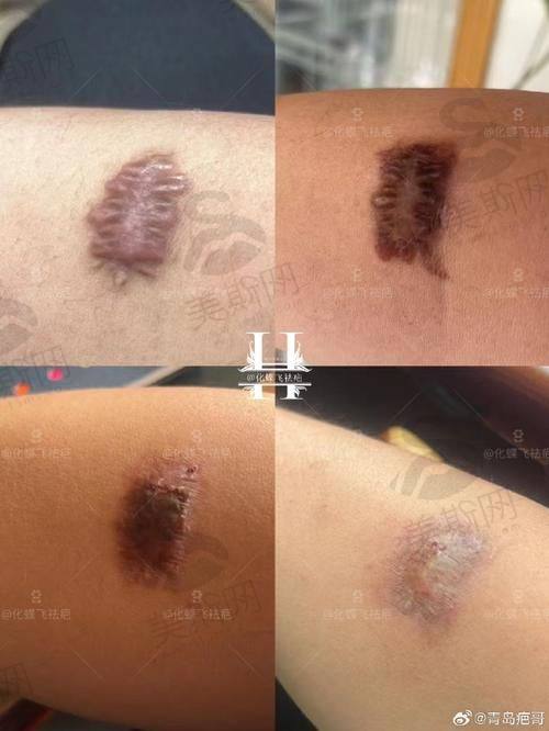 成都看疤痕疙瘩具有影响力医生刘宏杰