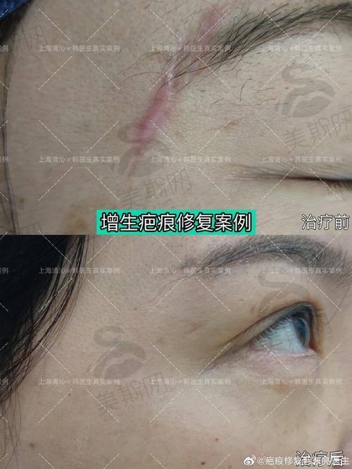 成都看疤痕疙瘩具有影响力医生段西凌