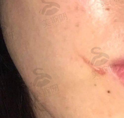 成都看疤痕疙瘩具有影响力医生李利