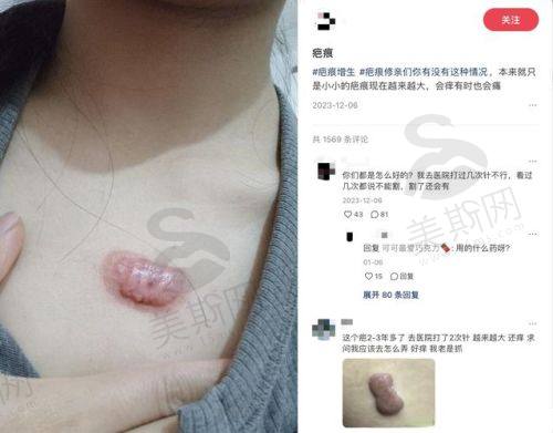 成都看疤痕疙瘩具有影响力医生蒋献