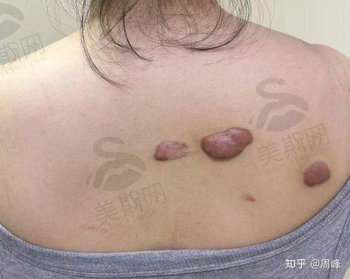 成都治疗疤痕疙瘩具有影响力医院及科室优势