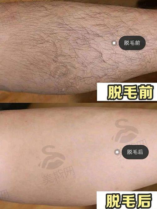 2、太原市第三人民医院整形美容科——太原激光脱毛哪里更好之综合优质选择