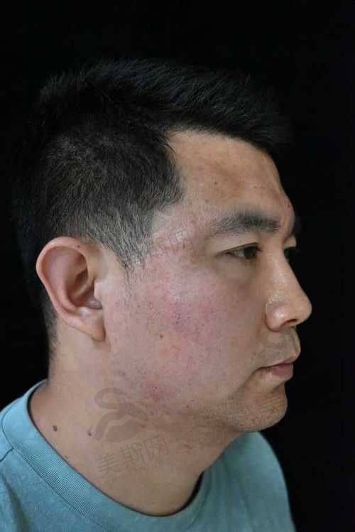 广州半岛黄金微针价格对比表（2025）