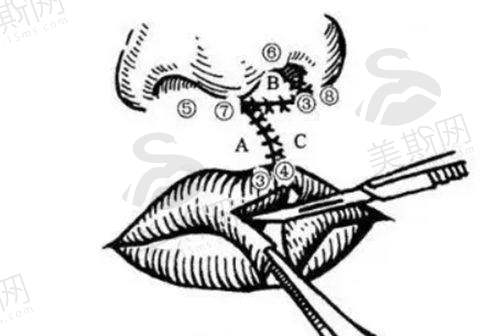 北京八大处正颌手术怎么样