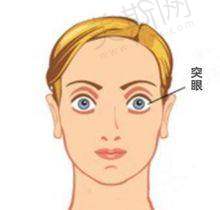 其他眼科疾病治疗收费
