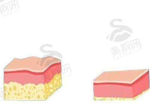 北京八大处隆胸手术价格
