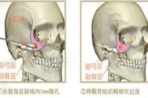 银川第一人民医院整形美容科实例介绍