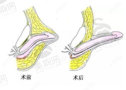 东莞泗安医院点阵激光项目科普