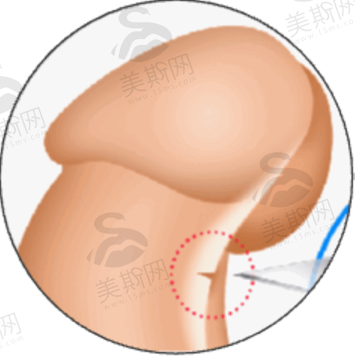 吸脂收费价格表