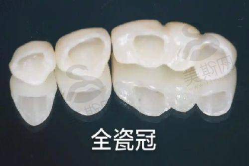 杭州美奥口腔医院种植牙贵不贵?医院是否正规、地址在哪及收费价目表全揭秘