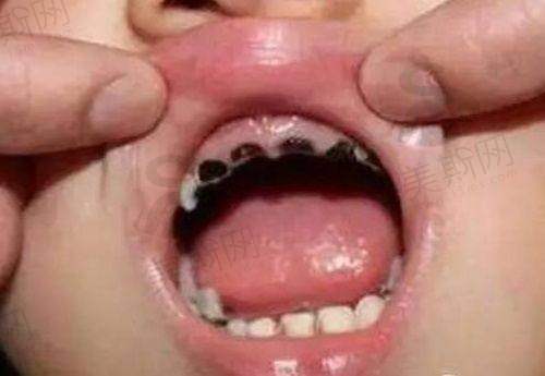 牙疼难忍一定要拔牙吗