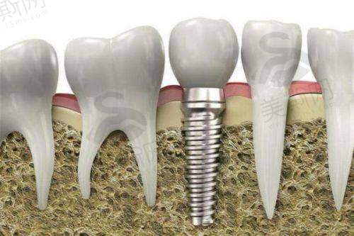 牙齿美容术后护理指南:这样做让成效多维持5年!