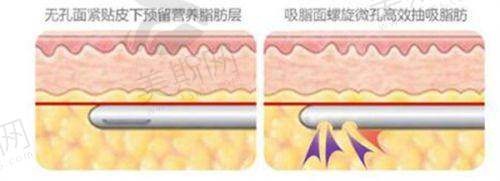 王召东医生做双眼皮手术的技术优势