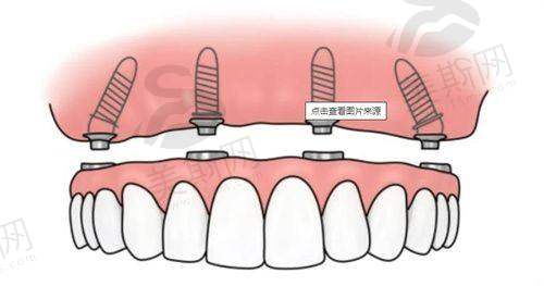 一颗牙冠多少钱：进口全瓷牙2000元起，国内外品牌为何“贵得有道理”