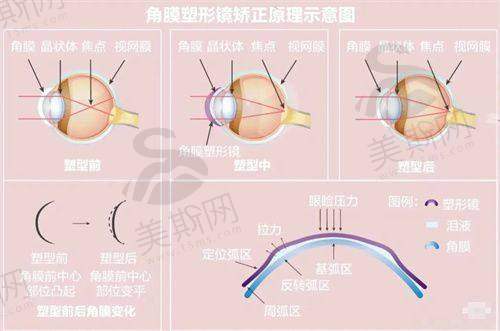 博士伦人工晶体是国产还是进口？主流型号与功能对比