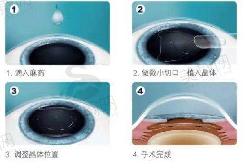 蔡司晶体散光适配解析——哪些型号能精细“驯服”散光