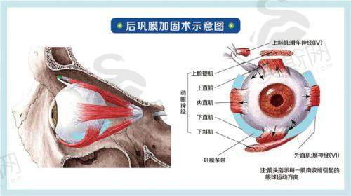 强生晶体是进口的吗?进口技术如何支撑“视觉质量升级”