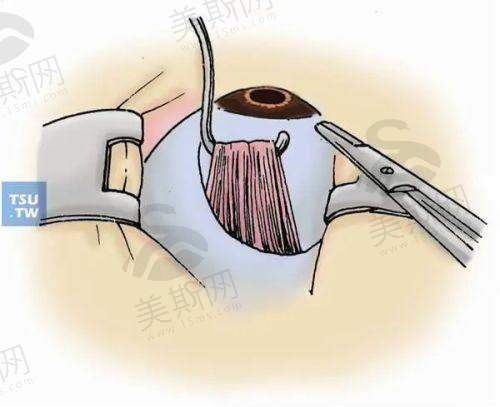 如何选择适合自己的博士伦晶体型号？
