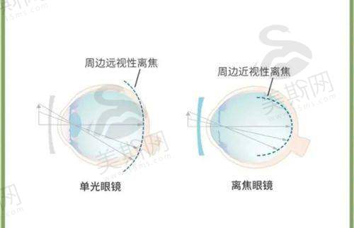 蔡司晶体对比选哪个？2025价格/散光适配/603p型号3大维度解析