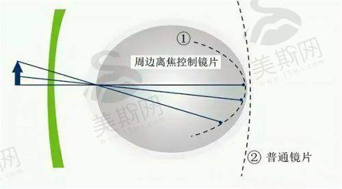 黄斑病变治疗后视力保护：长期管理的