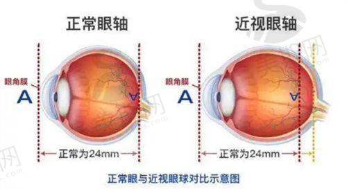 博士伦人工晶体akreos vs 其他品牌：优势在哪里
