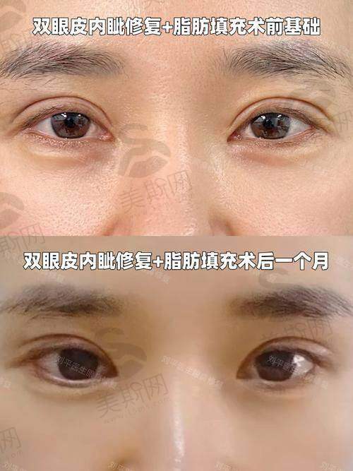 成都杨迪眼周筋膜提升价格表|2万-4万元起技术靠谱，附杨迪医生简介+双眼皮修复案例对比