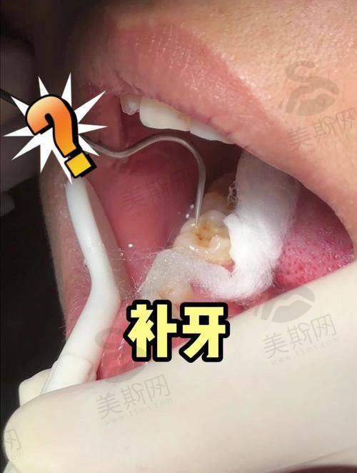 虫牙修补多少钱一颗？2025单颗收费标准详解