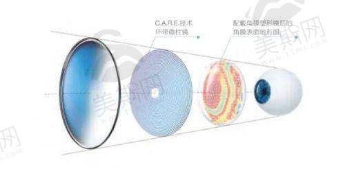 云南大学附属医院眼科近视手术价格表图片