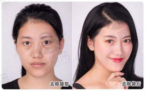 厉害的免拆线人中缩短术