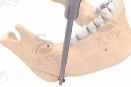 李献和医生唇裂二期修复口碑展示