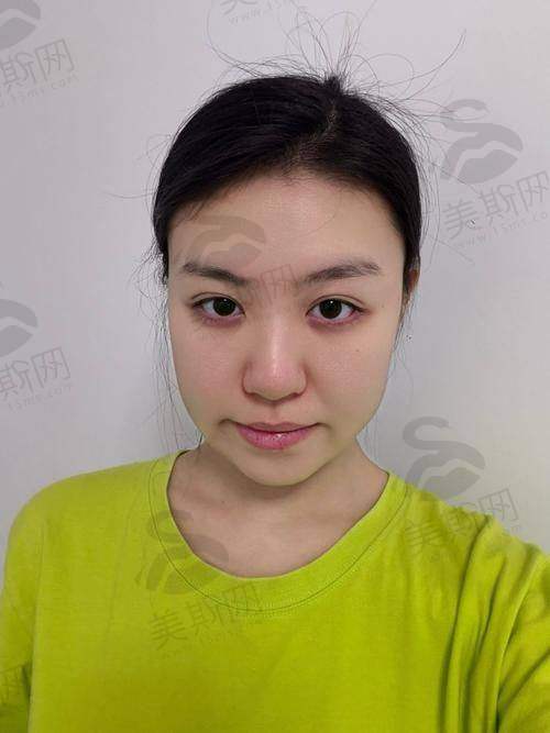 重庆松山朱乐林下颌角截骨整形口碑：3位求美者的真实变得更美故事