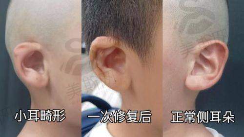 李献和医生唇裂二期修复手术价格解析