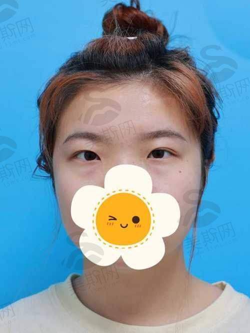2. 眼鼻精细化整形