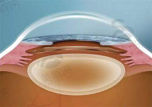 总结：15000元起始投资，开启高清人生新篇章