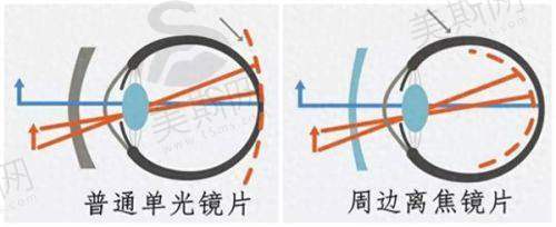 四、重庆佰视佳眼科赵小虎飞秒技术真实口碑三位患者的清晰视界之旅